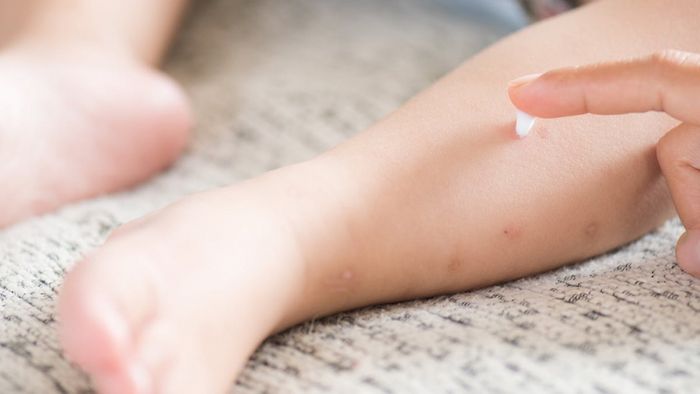 Bayi Anda di Gigit Nyamuk? Inilah 5 Cara Mengobati dan Menghilangkan Bekas Gigitan Nyamuk Secara Alami