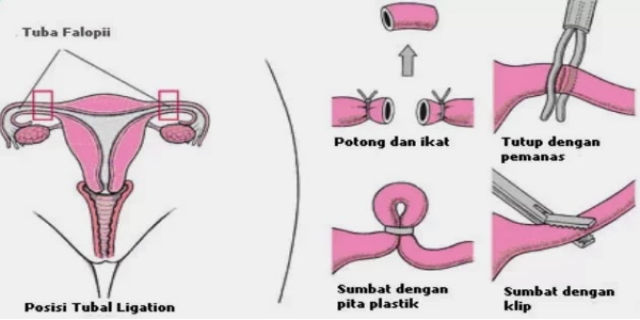 Mengenal KB Steril untuk Wanita, Terbukti Paling Ampuh?