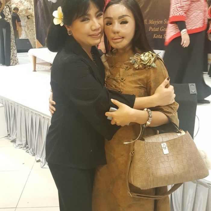 Lisa Korban Air Keras, Tegar Hadapi Ujian Hidup Kini Sukses Jadi Pengusaha Perhiasan